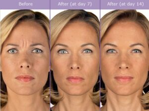 Botox Cosmetic Treatment: The Art of Wrinkle Smoothing and Rejuvenation in Chantilly