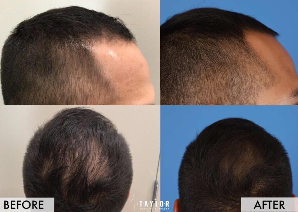 exosome hair results