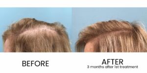 exosome-hair-results-b4-and-after-1